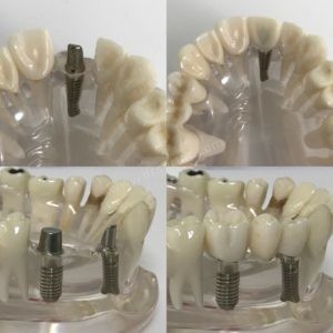 İmplant Diş Yapımı Modeli