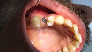 Tek implant diş iyileşme başlığı